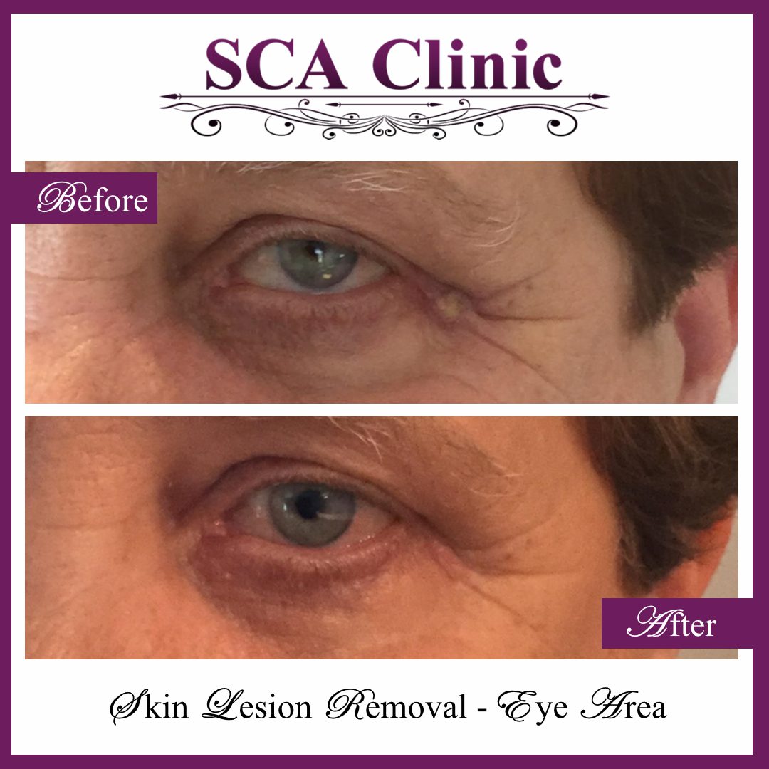 SCA Clinic before & after Skin Lesion Removal