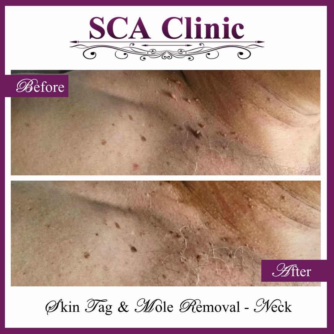 SCA Clinic before & after Skin Tag & Mole Removal