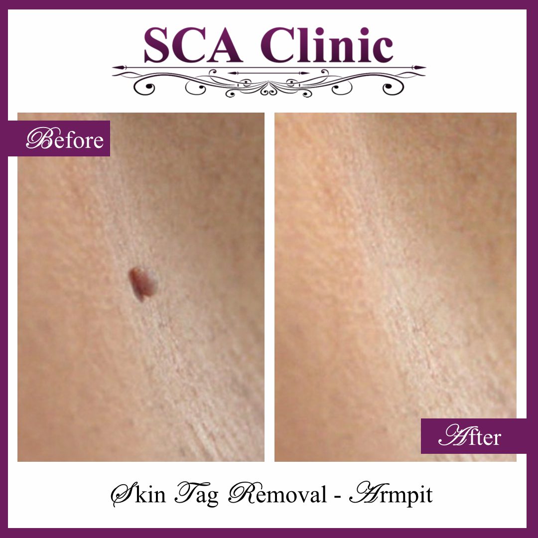 SCA Clinic before & after Skin Tag Removal - A